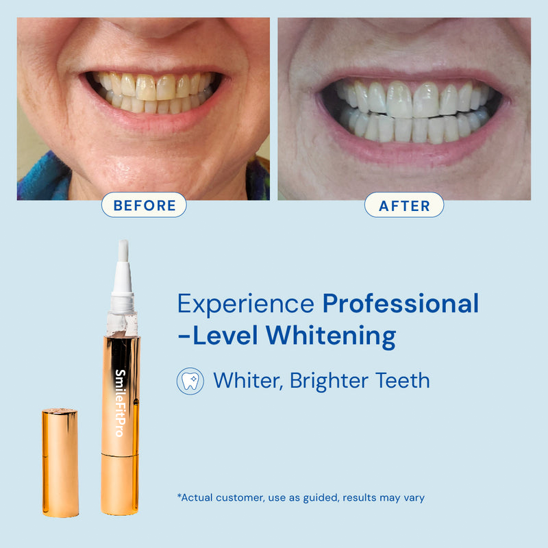 SmileFitPro™ - Teeth Whitening Serum Pen