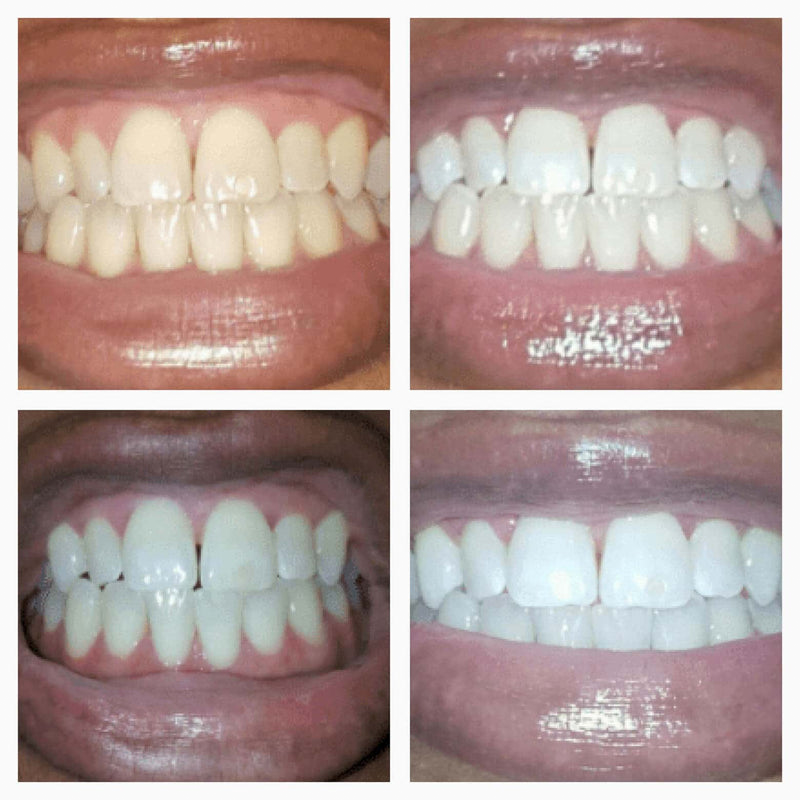 SmileFitPro™ - Teeth Whitening Serum Pen