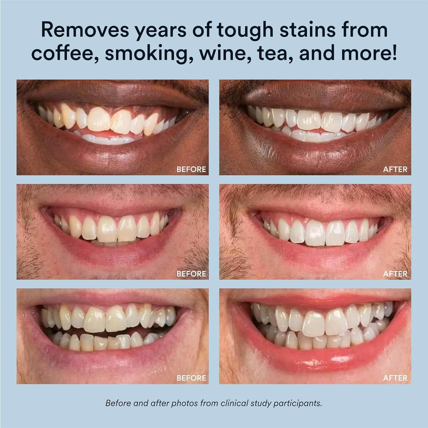 Auraglow Teeth Whitening Pen