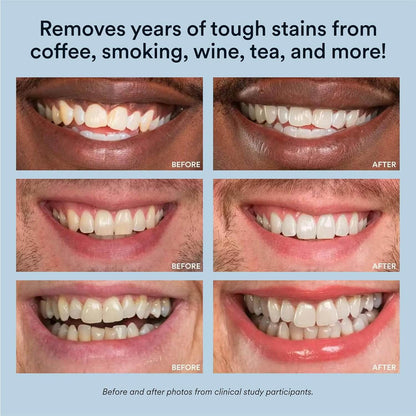 Auraglow Teeth Whitening Pen